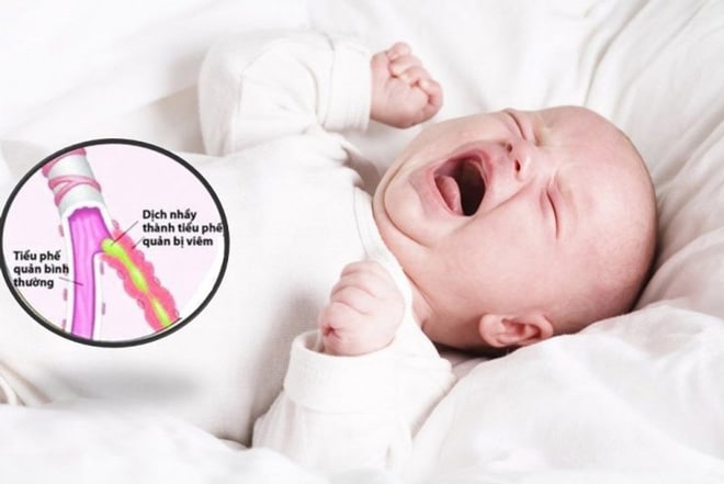 Trẻ bị viêm phế quản, viêm phổi là nguyên nhân khiến bé bị khò khè